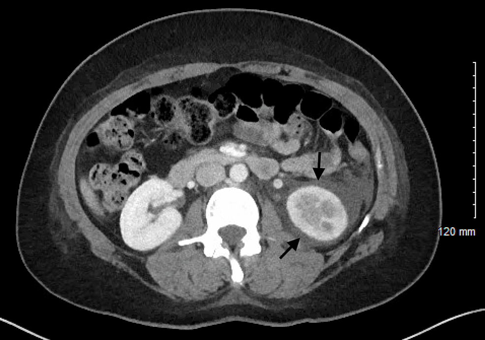Computed-tomography-(CT)-abdomen-and-pelvis-with-contrast-showing-abnormal-hypo-enhancement-of-the-inferior-half-of-the-left-kidney-with-prominent-perinephric-fluid-(arrows)-in-a-patient-with-left-renal-vein-thrombosis