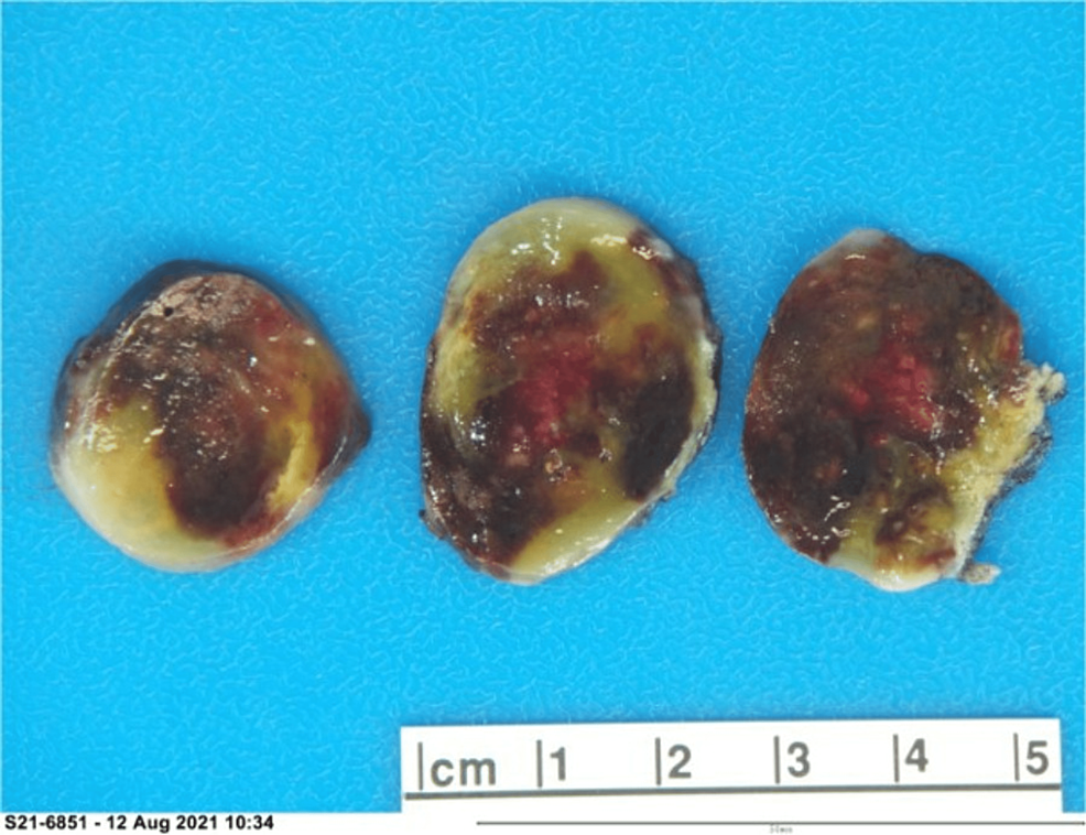 A Left Atrial Myxoma Masquerading As Acute Coronary Syndrome Cureus
