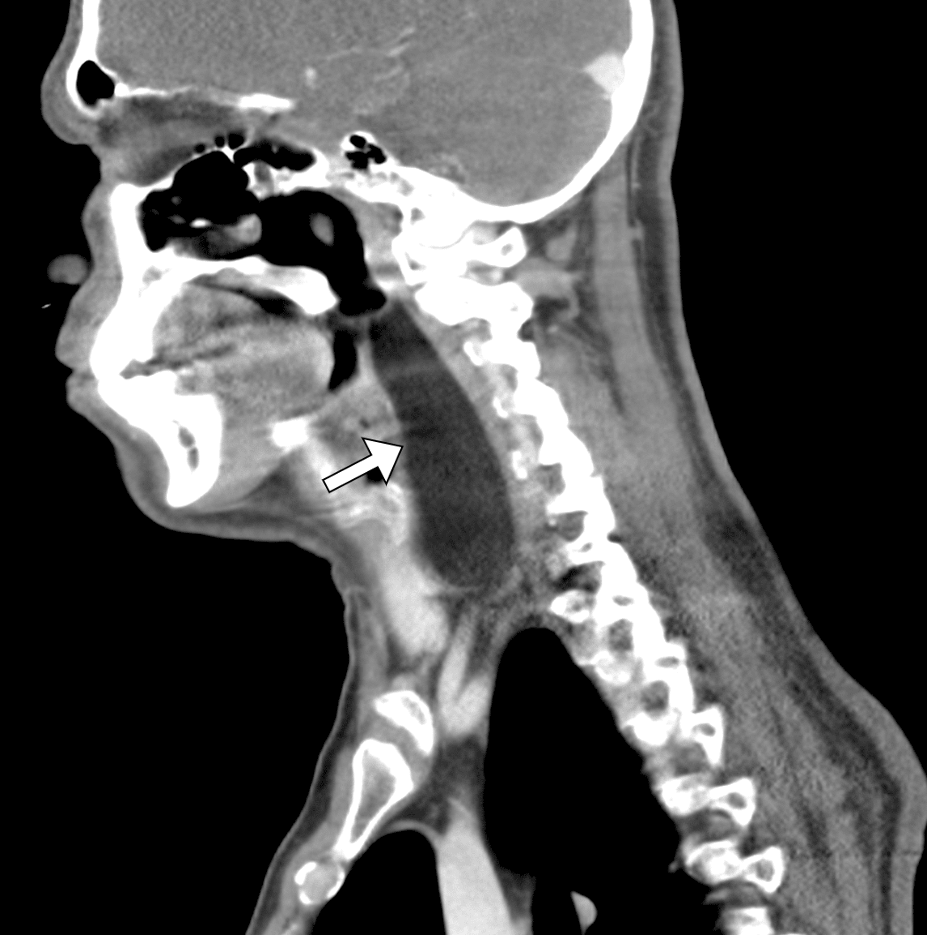 Cureus A Giant Retropharyngeal Lipoma A Case Report And Review Of Literature 