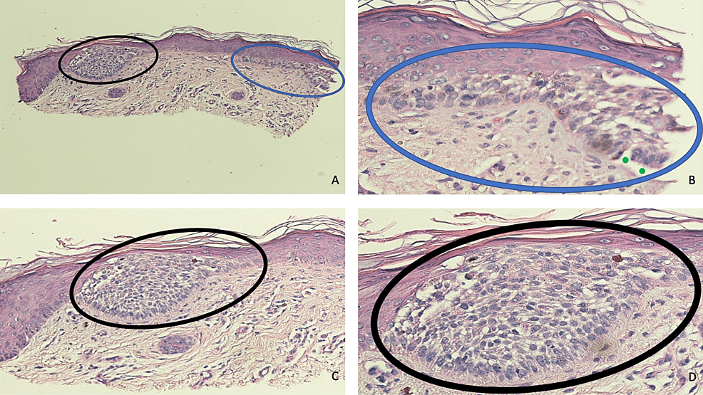 Pathologic-features-of-a-basal-cell-carcinoma-in-situ-of-the-skin.