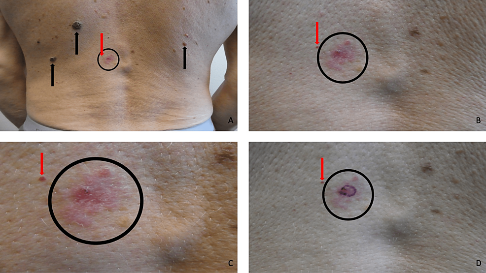 Cutaneous-basal-cell-carcinoma-in-situ-presenting-as-an-asymptomatic-plaque-on-the-back.