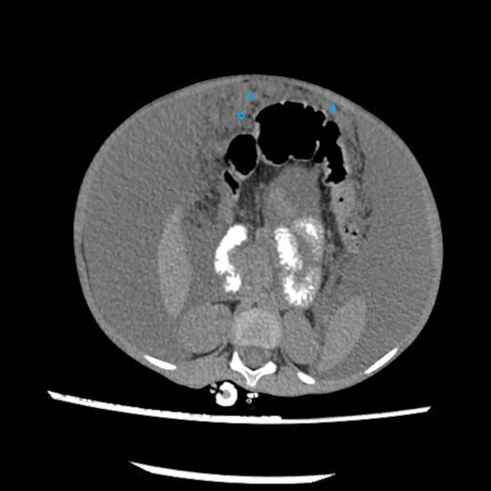 Computed-tomography-(CT)-scan-of-abdomen-with-contrast-showed-omental-thickening-and-nodularity-(arrows).