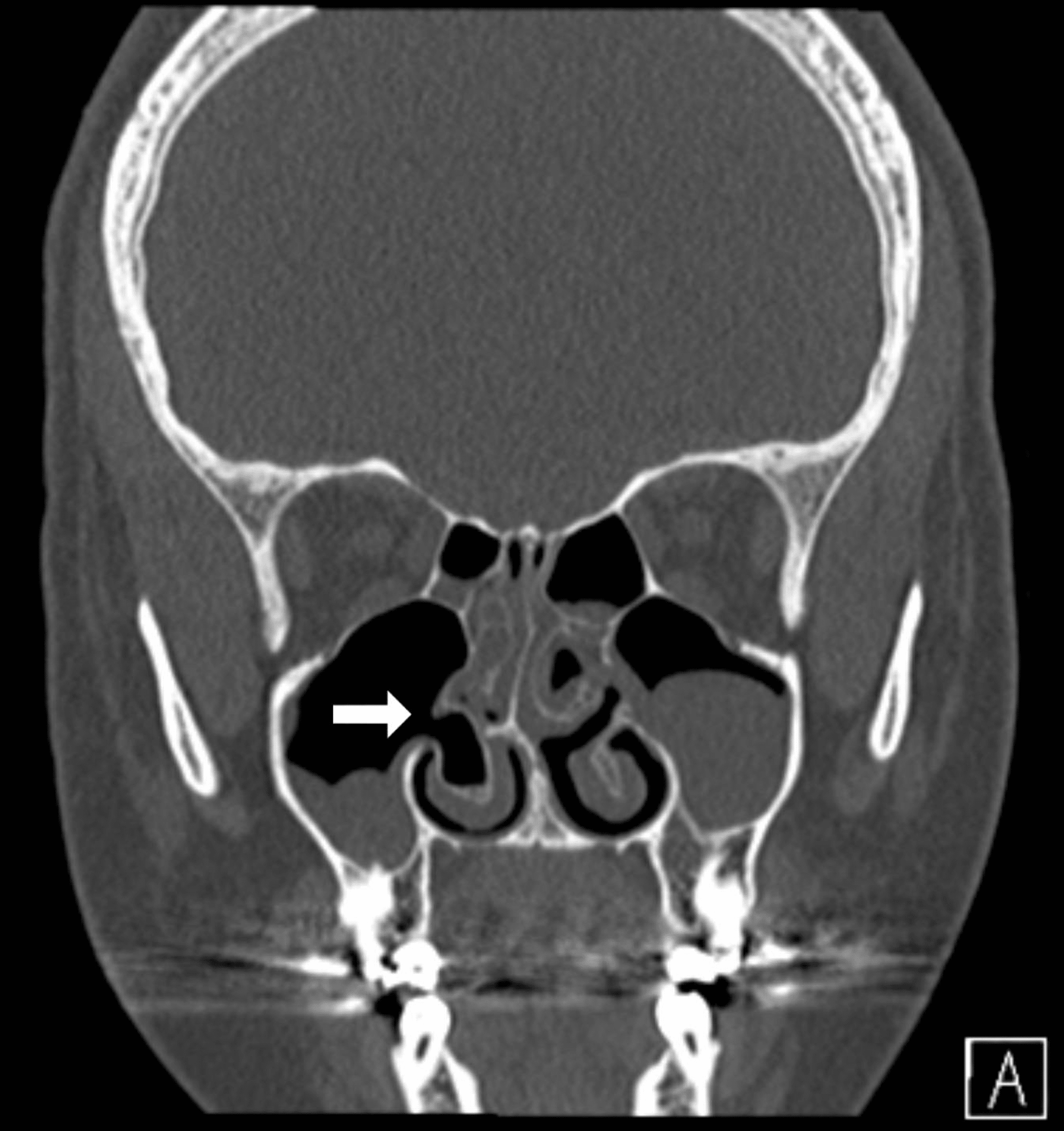 Cureus Pneumatized Inferior Turbinate A Report Of Three Cases 1493