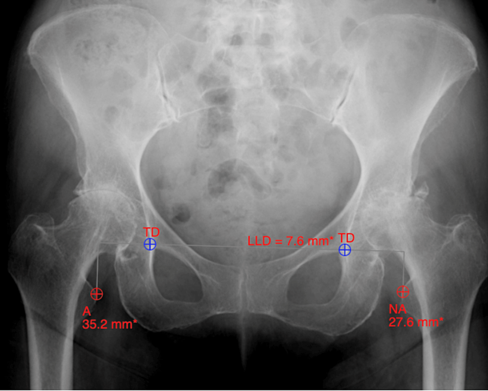 Hip Replacement Surgery – An Overview - VIMS