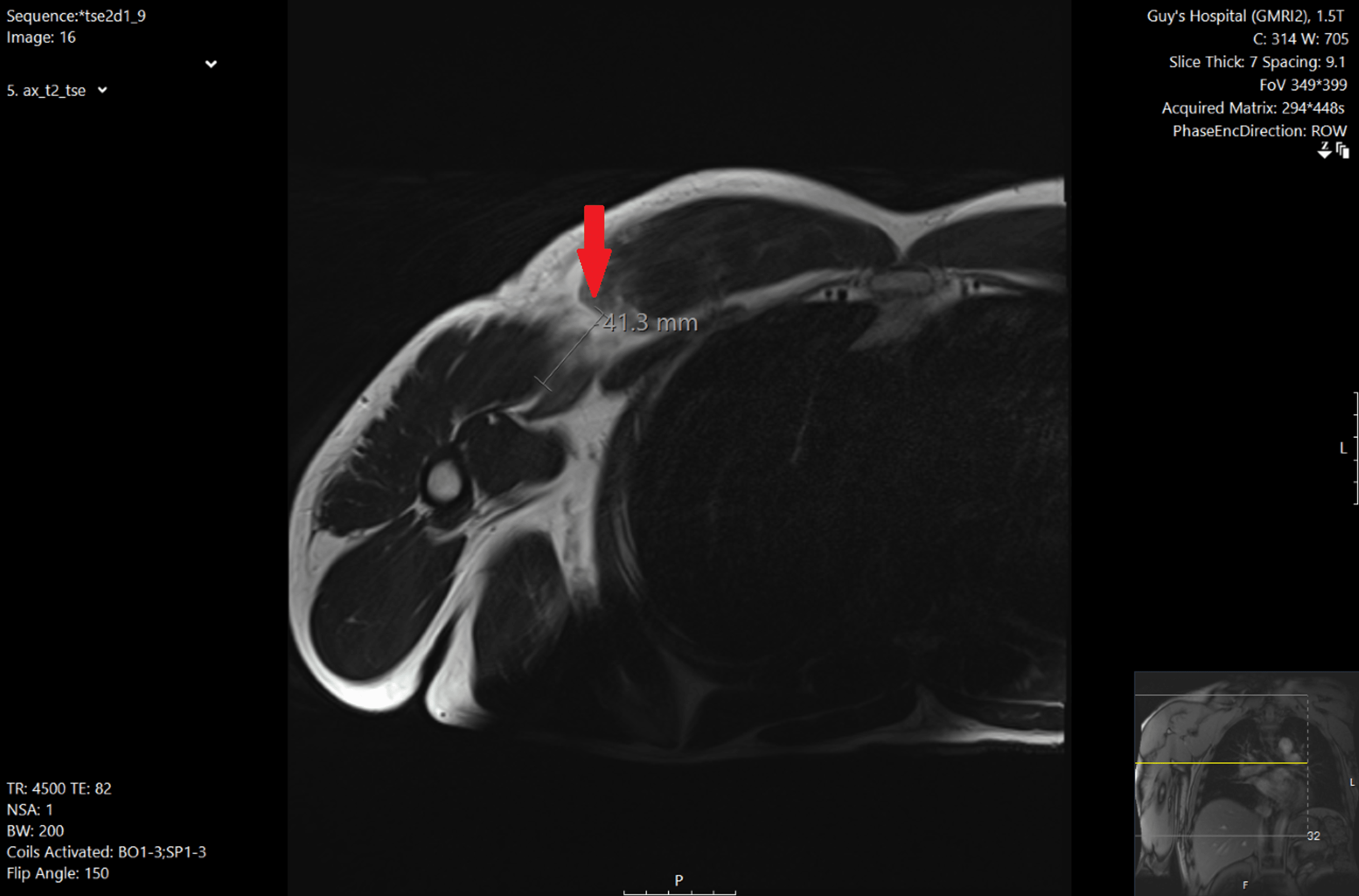 Figure 1 From Pectoralis Major Tendon Rupture Mr And