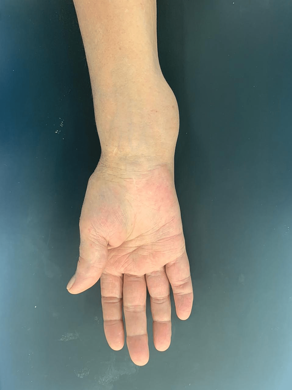 rheumatoid nodules wrist