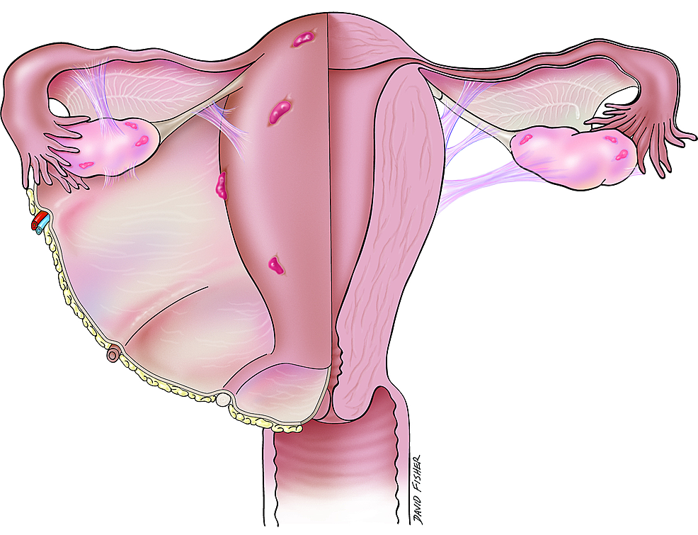 Schematic-drawing-of-areas-often-involved-in-endometriosis.