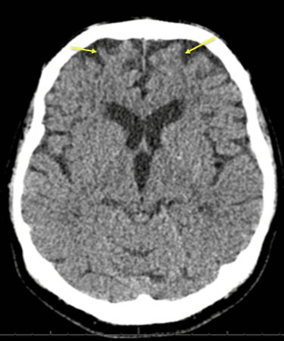 Non-contrast-computed-tomography-of-the-head-with-nil-acute-findings.-Normal-ventricles-and-basal-cisterns.-Some-atrophy-of-the-frontal-lobes-appeared-advanced-for-the-patient’s-age-(yellow-arrows).