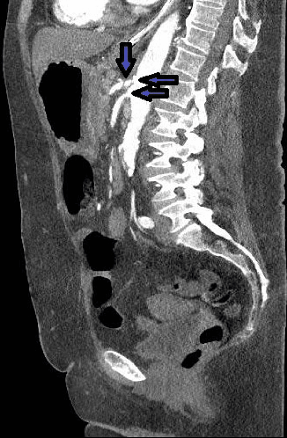 Diffuse Arterial Atherosclerosis Presenting With Acute Ischemic