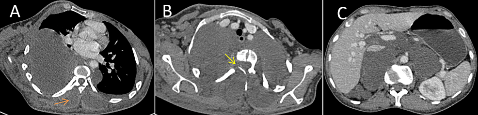 Post-contrast-thoracoabdominal-CT-scan.