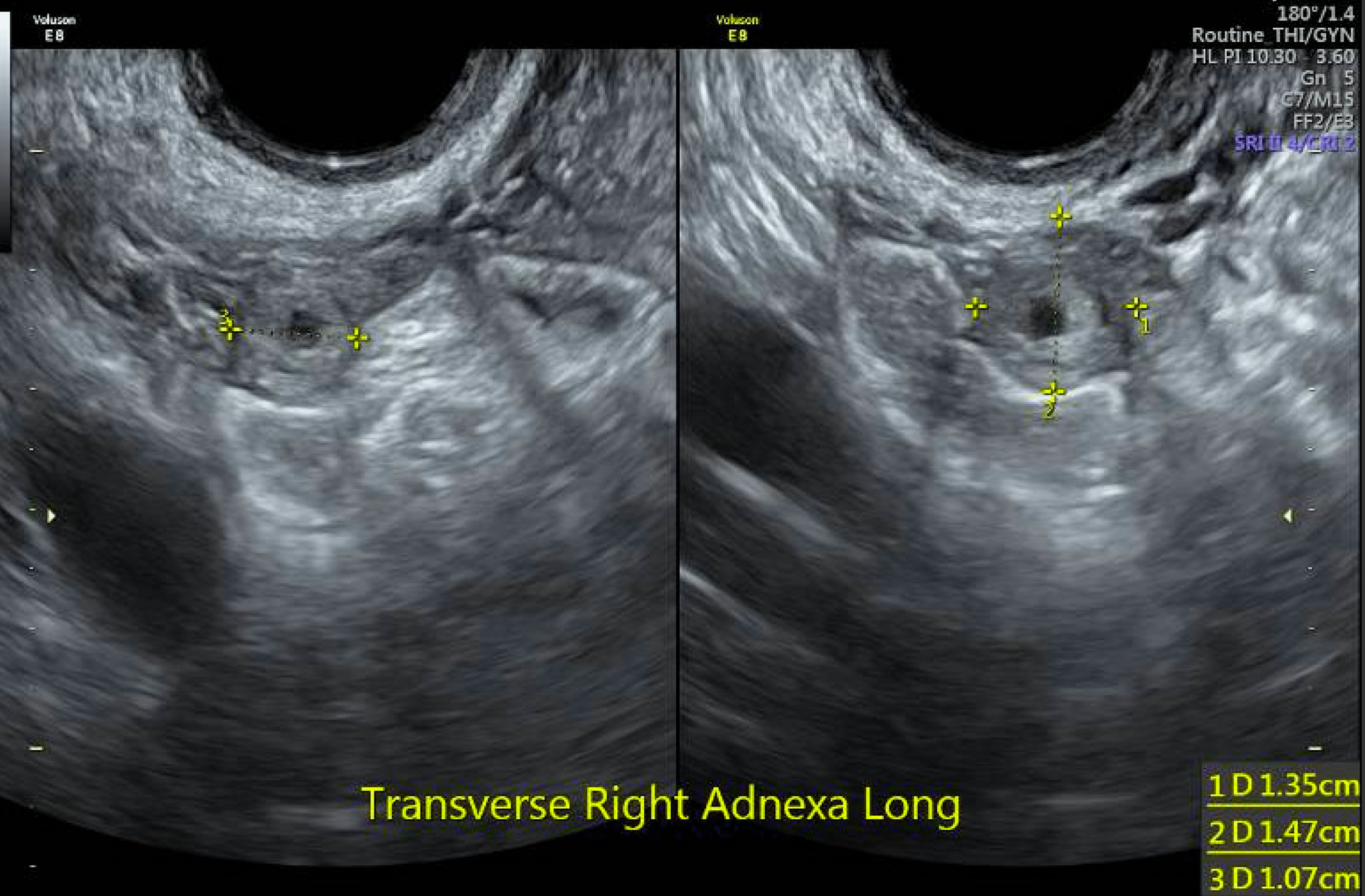 Cureus | Spontaneous Bilateral Ectopic Pregnancy Treated With ...