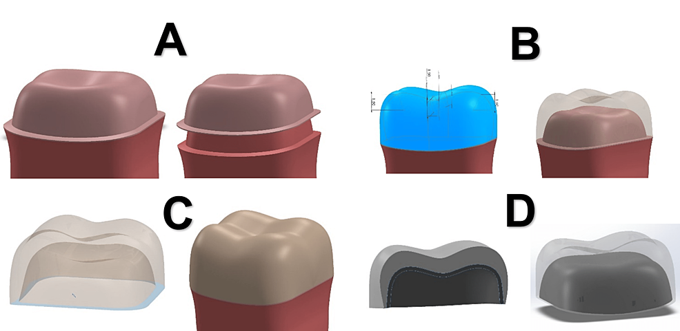 Three-Dimensional Finite Element Analysis of Worn Molars With Prosthetic Crowns and Onlays Made of Various Materials