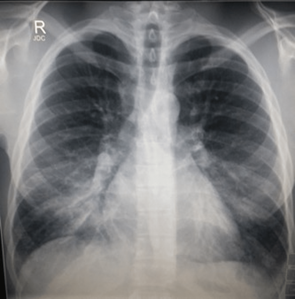 An-upright-chest-radiograph-with-silhouetting-of-the-right-heart-border-and-air-bronchograms.