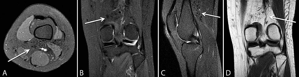 MRI-Left-Knee