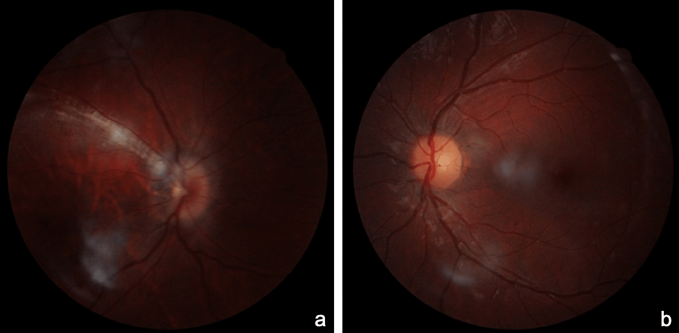 Cureus | Straatsma Syndrome: A Case Series