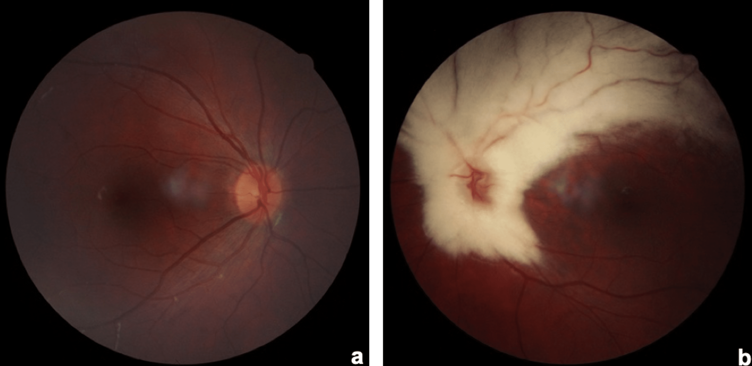 Cureus | Straatsma Syndrome: A Case Series