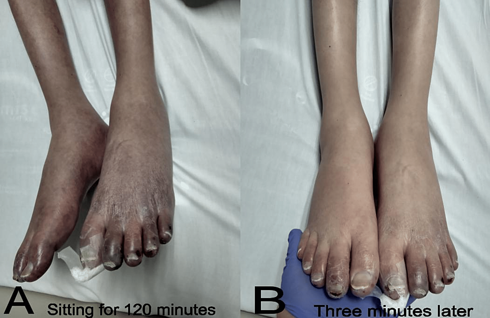 Cureus Secondary Acrocyanosis in a Paraplegic Patient With Spinal