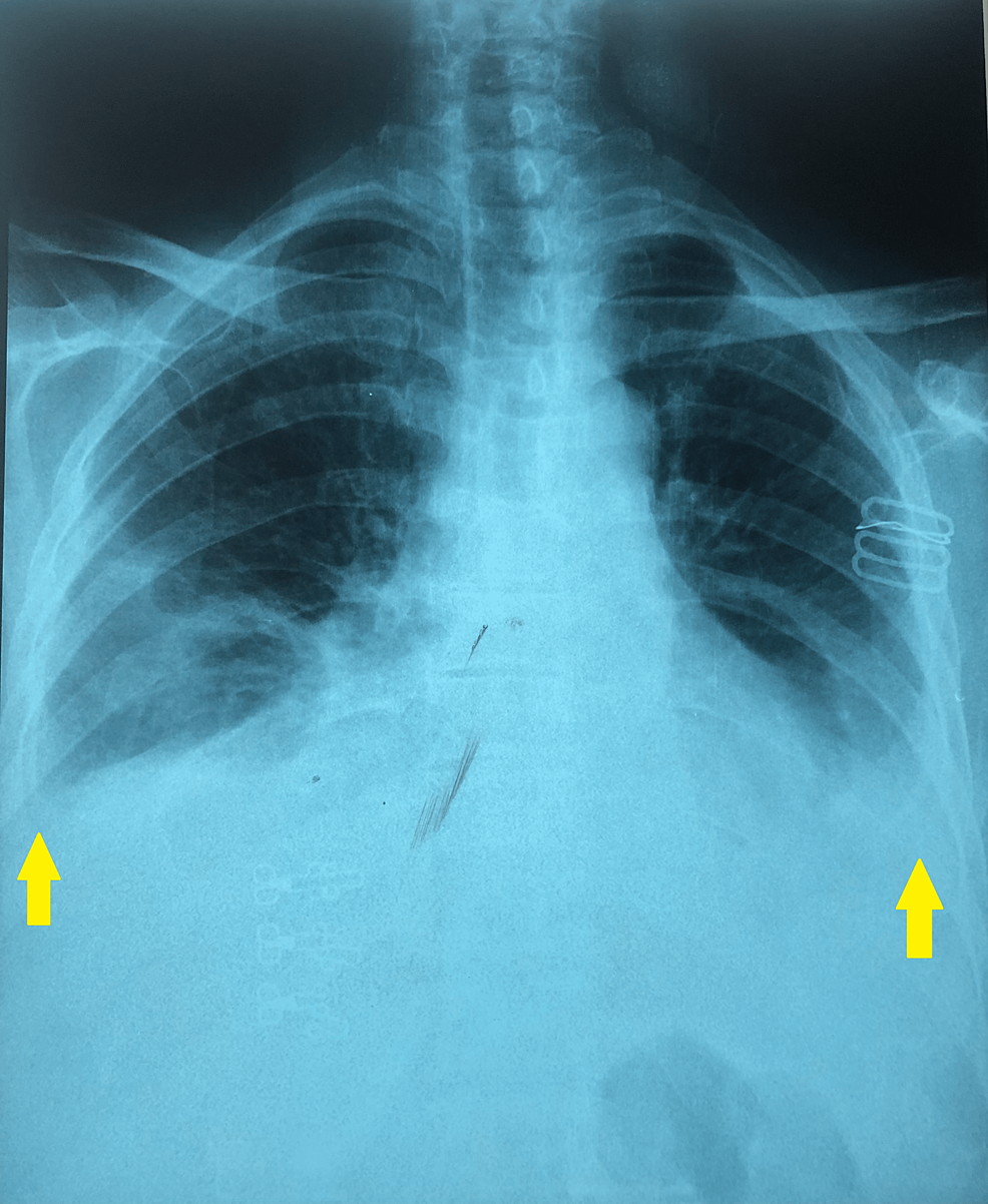 Chest X-ray shows moderate bilateral pleural effusion (yellow arrows).