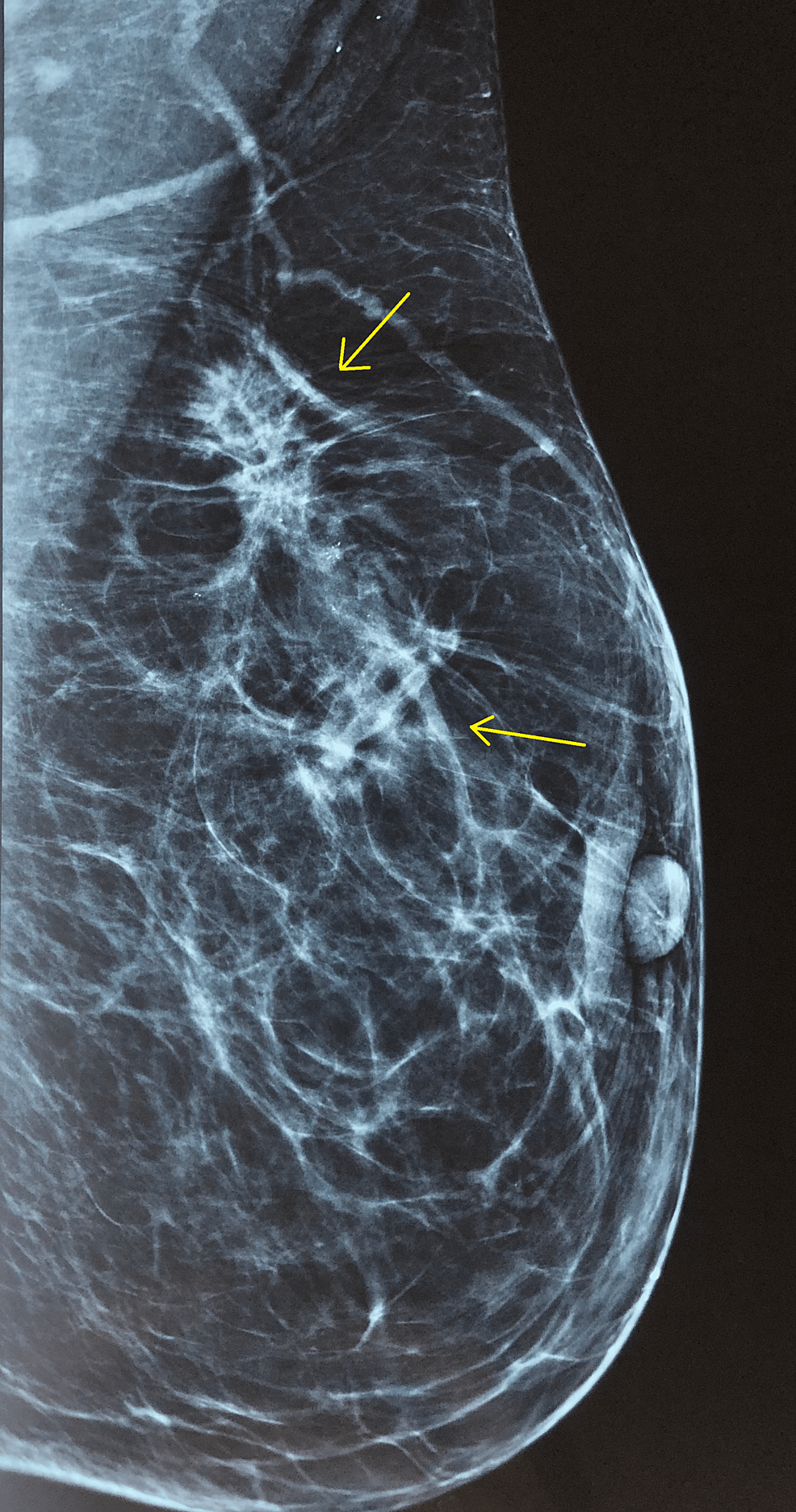 The left mammogram revealed-an-irregular-shape-nodule-with-measurements-of-24×13mm-in-the-upper-outer-quadrant-of-the-left-breast-and-another-nodule - Measurement-12×10mm-at-junction-of-upper-quadrants-(yellow arrows).