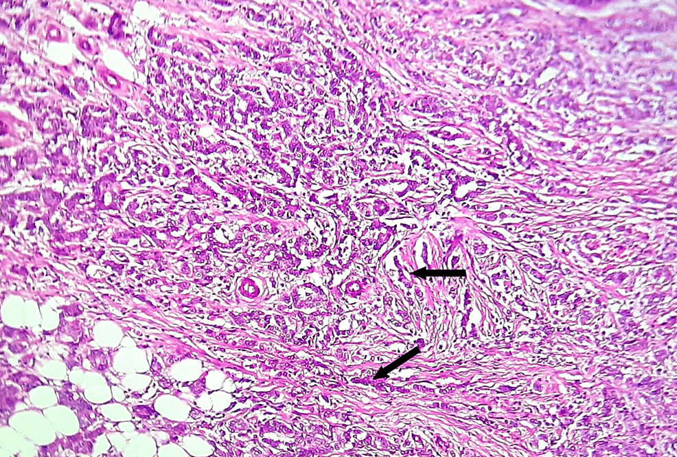 Histological section shows tumor proliferation arranged in discrete files (arrow), cords, discrete cells, and rare glands. The tumor cells were discohesive, small, monomorphic, and absent -marked-atypia.