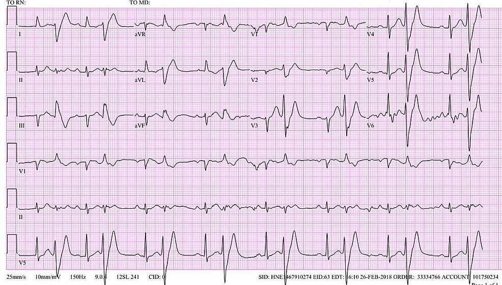 Baseline-electrocardiogram-(EKG)-demonstrating-ventricular-bigeminy.