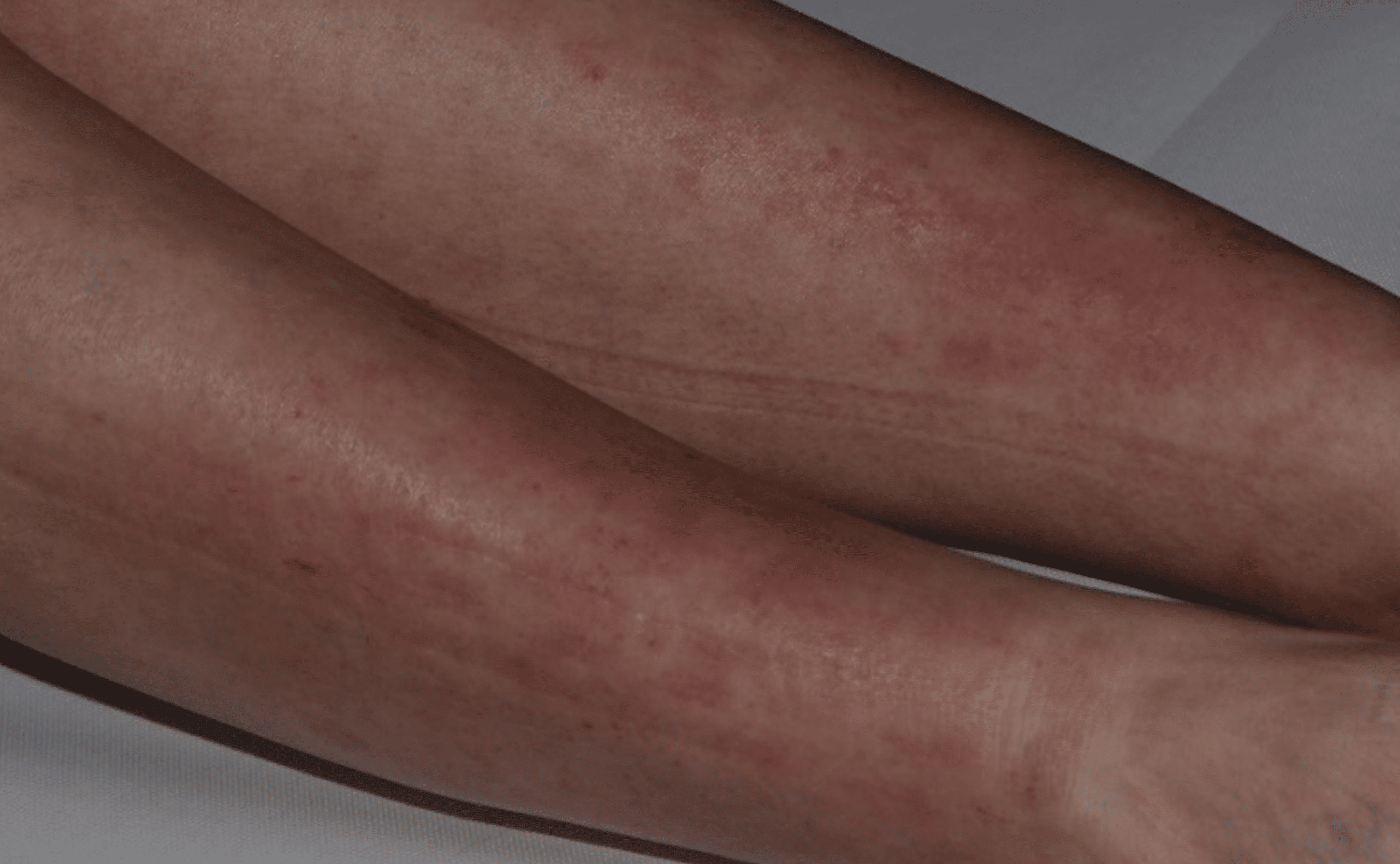 Cureus Urticarial Vasculitis Associated With