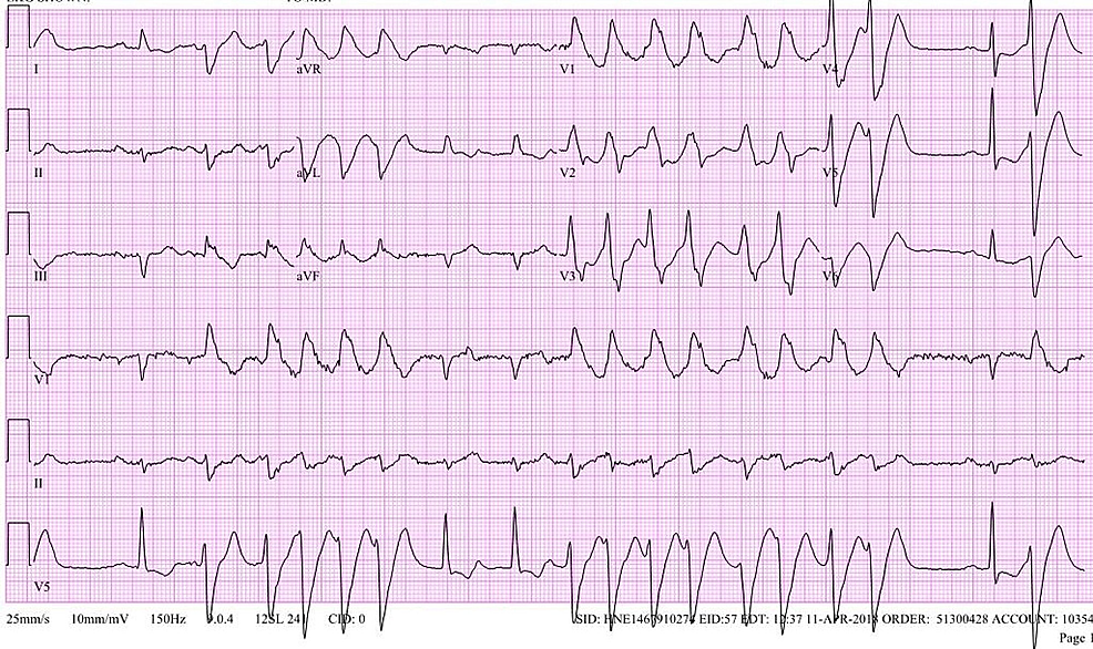 Electrocardiogram-(EKG)-of-patient-demonstrating-ventricular-tachycardia-with-occasional-sinus-rhythm.