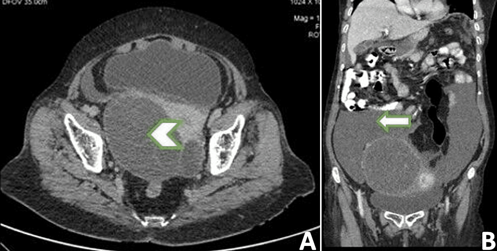 Contrast-enhanced-computed-tomography-of-abdomen-and-pelvis:-(A)-axial-view-and-(B)-coronal-view