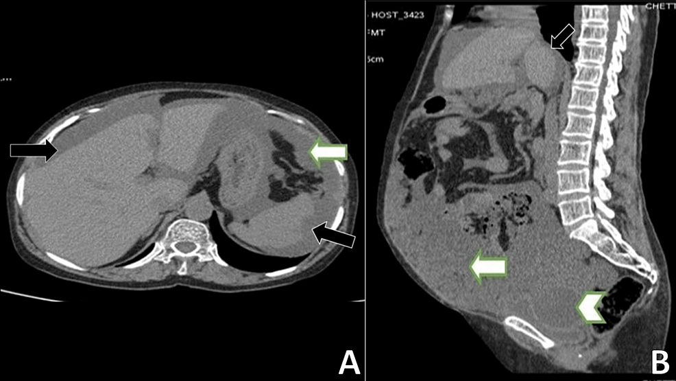 CT-abdomen-and-pelvis:-(A)-axial-view-and-(B)-sagittal-view