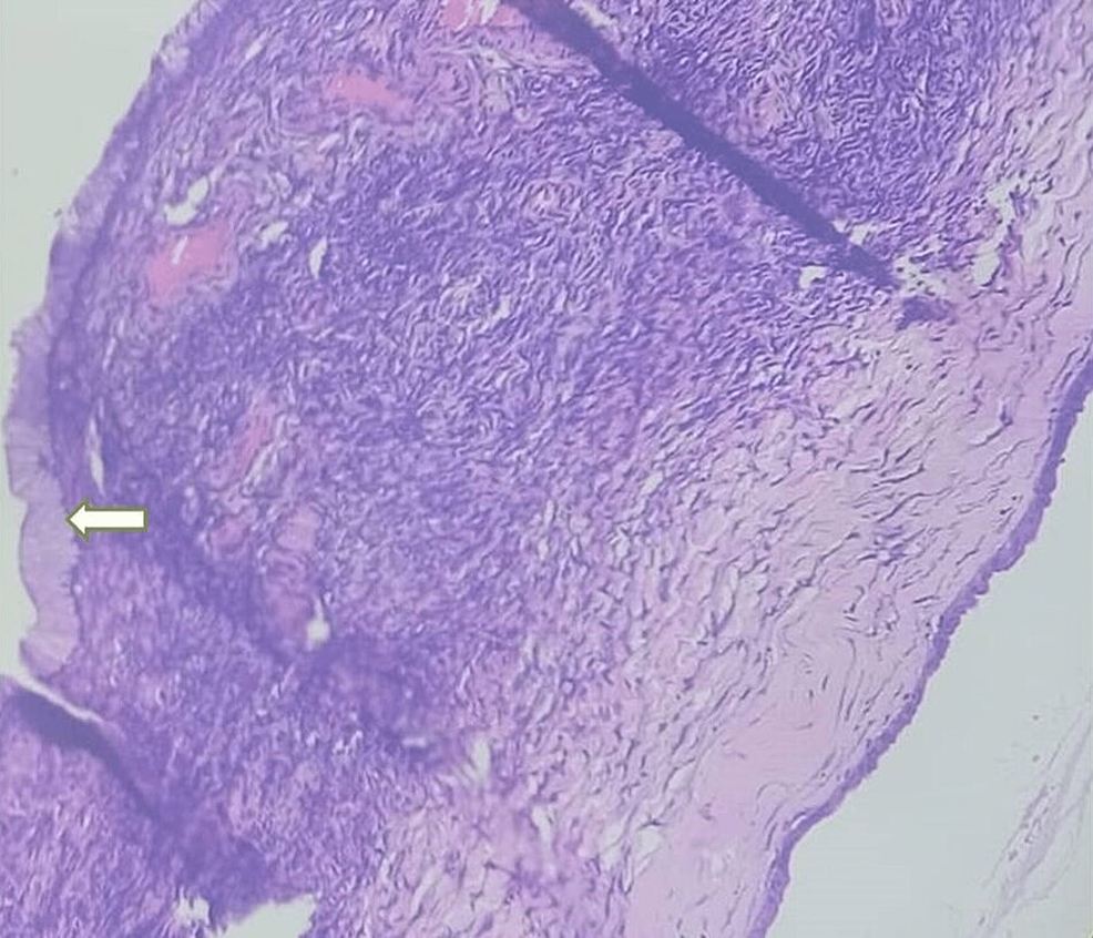 Benign-mucinous-ovarian-cystadenoma