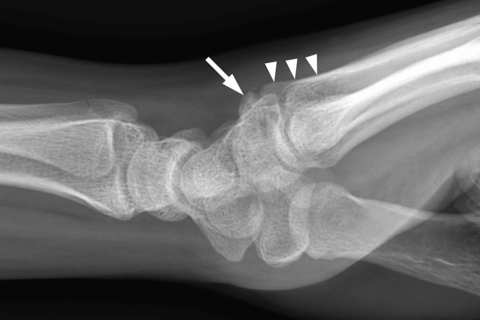 Cureus | Ultrasonographic Diagnosis of an Os Styloideum in an ...