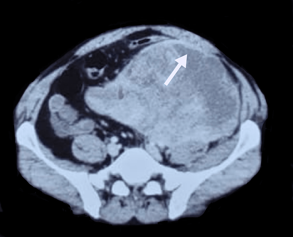 cureus-retroperitoneal-spindle-cell-rhabdomyosarcoma-with-compression