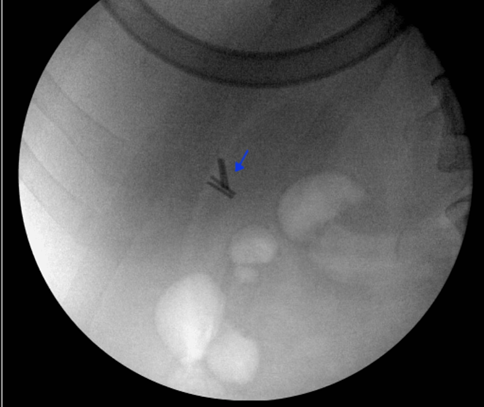 Diagnostic-laparoscopy-evaluation-with-fluoroscopic-guidance-located-the-positioning-of-four-metal-surgical-clips-(blue-arrow).