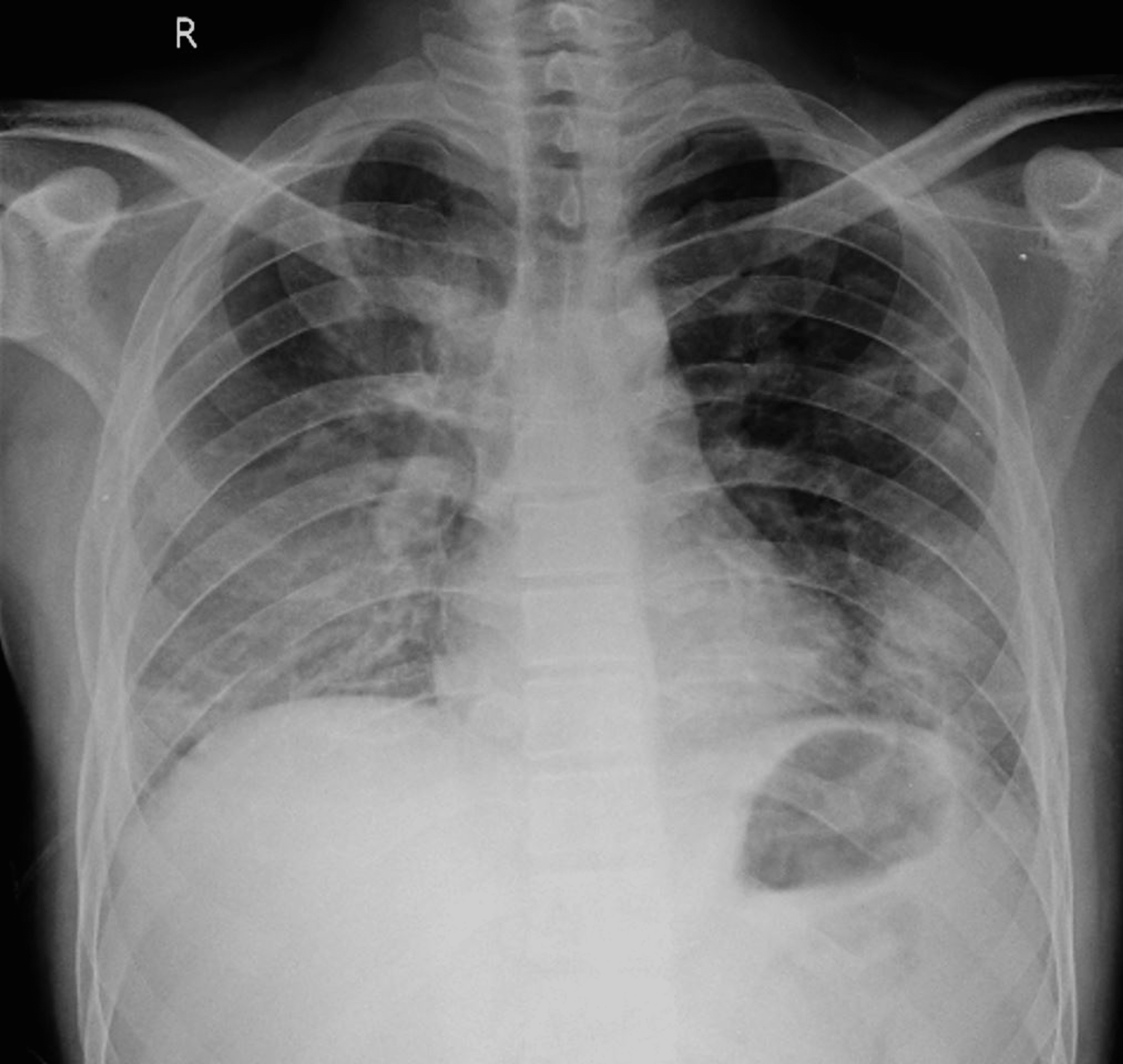 Cureus | Septic Pulmonary Embolism With Deep Vein Thrombosis and ...