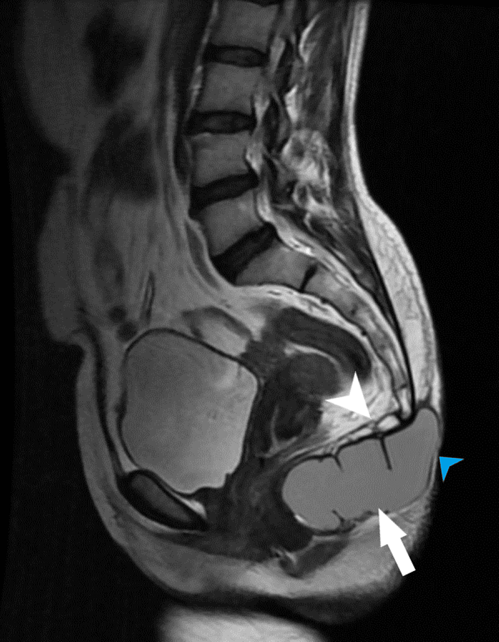 Sagittal-T2WI-image-showing-well-defined-hyperintense-lesion-in-the-perineal-area- (white arrow), -displacement-coccyx-superior- (white arrowhead).  The lesion extended to the subcutaneous level (blue arrowhead).  -