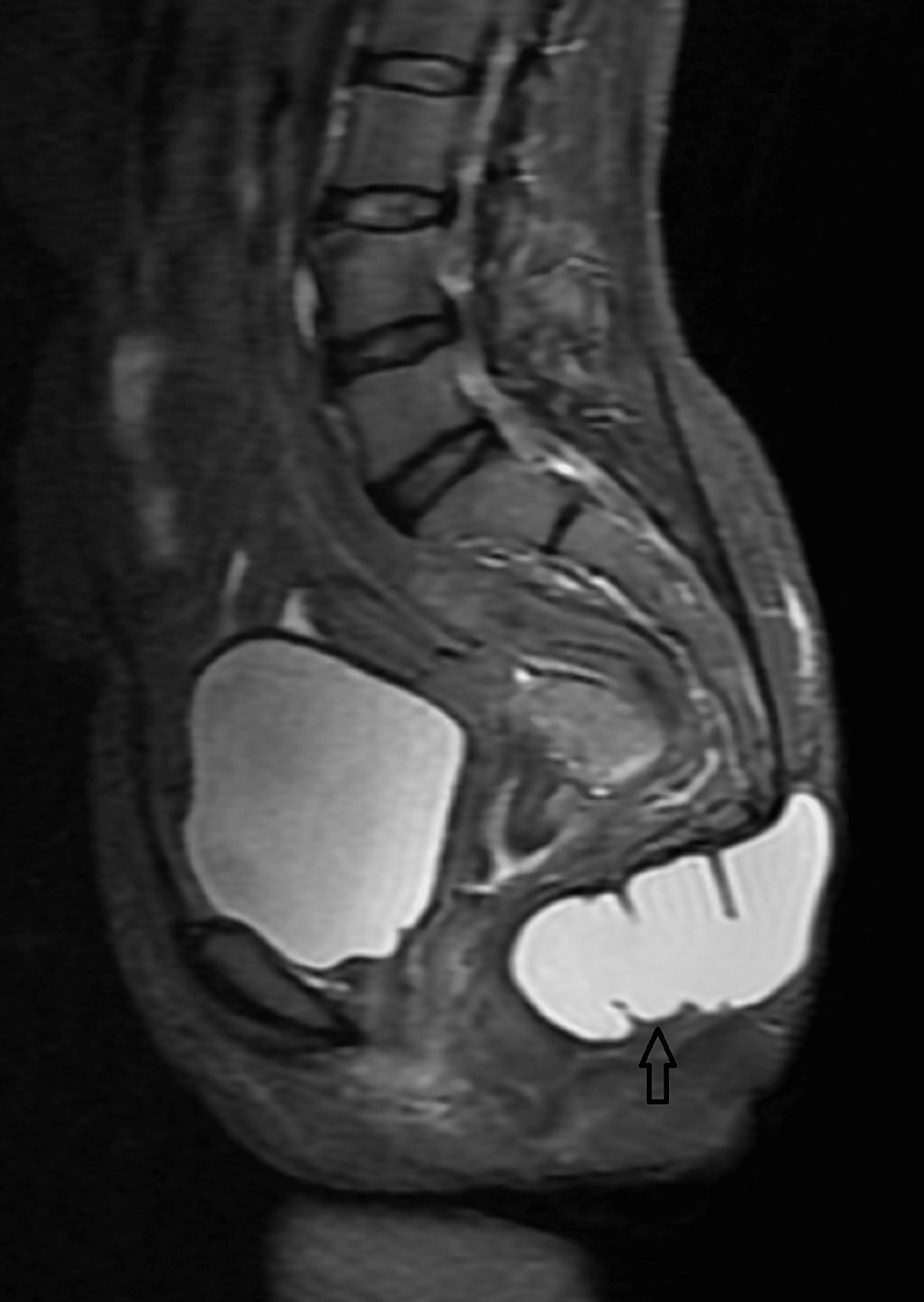 MRI-STIR-image-show-that-the-lesion-is-hyperintense- (black arrow) is shown in the sagittal segment.
