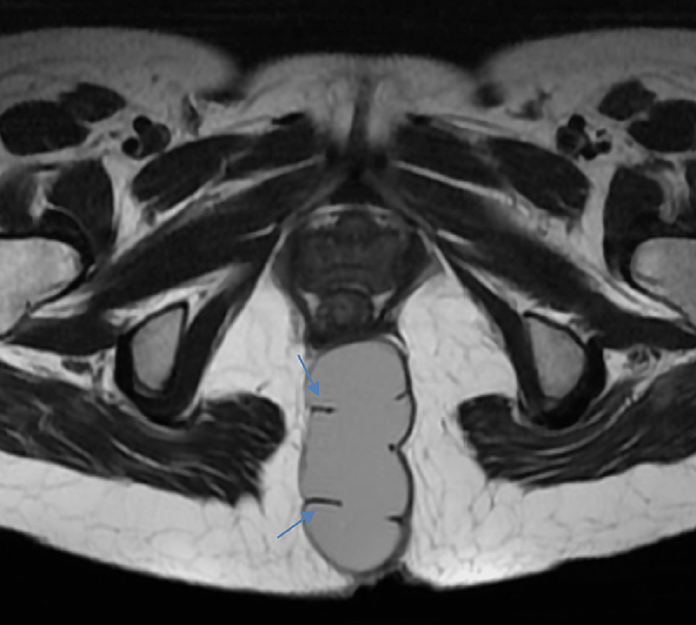 Axial - MRI-T2WI - Images showing - highly visible lesions - appearing - incomplete breaks - inside - (blue arrow).-