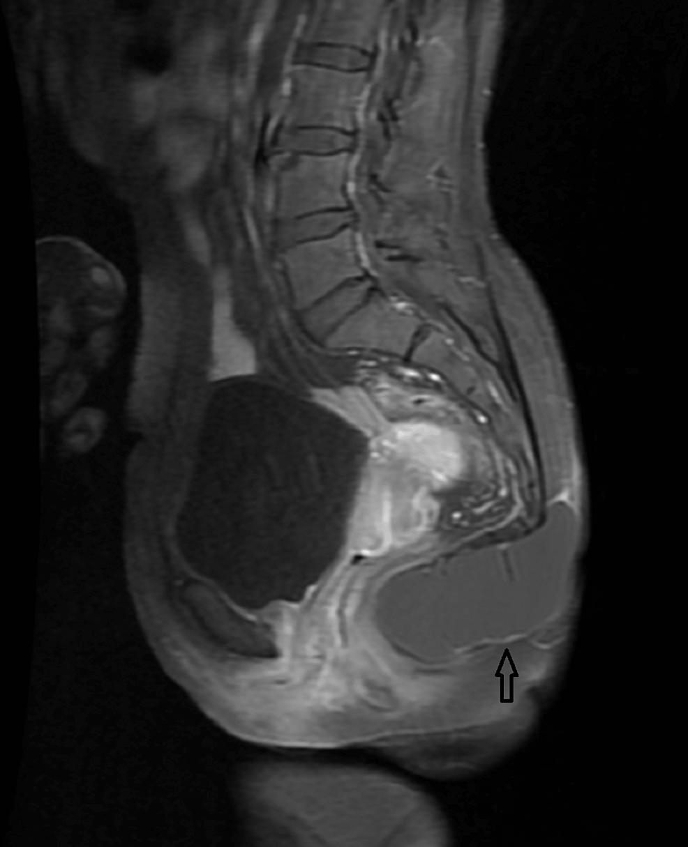 Contrast enhancer-T1WI-sagittal-MRI-image showing-precise peripheral enhancement-(black arrow).-