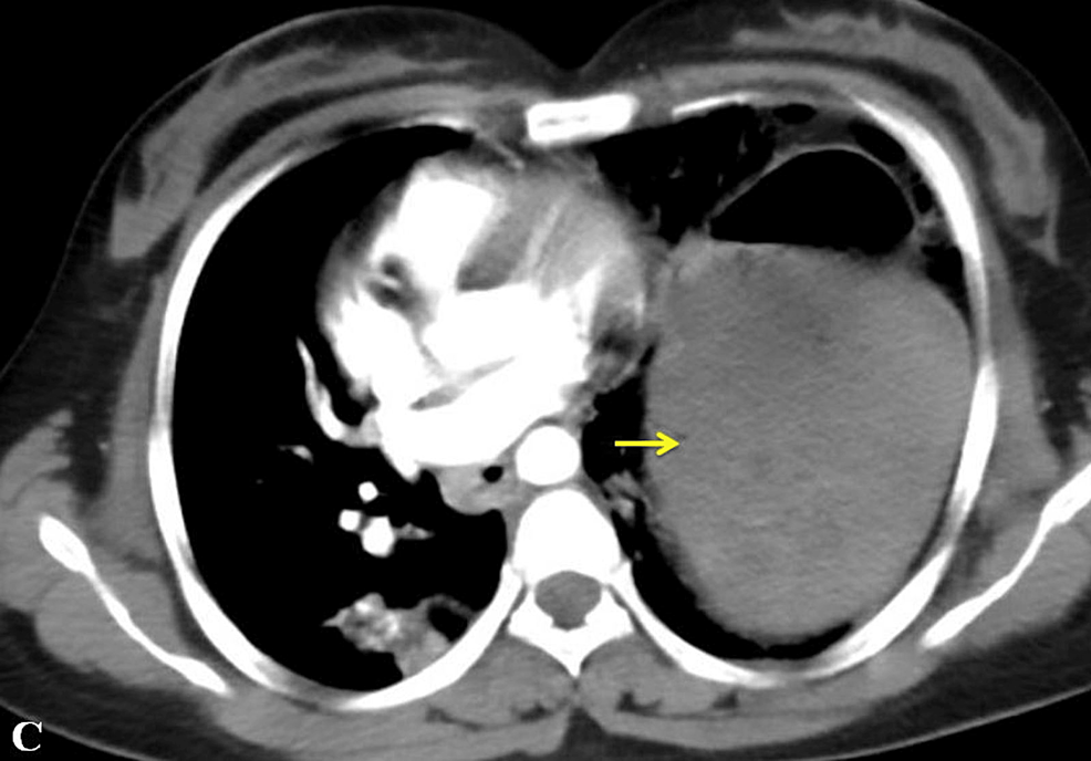 CT-thorax-showing-herniated-stomach-in-the-left-hemithorax-(arrow)-air-fluid-level.-