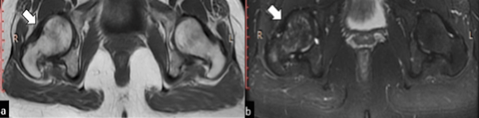 Follow-up-STIR-imaging-at-the-level-of-hip-joints