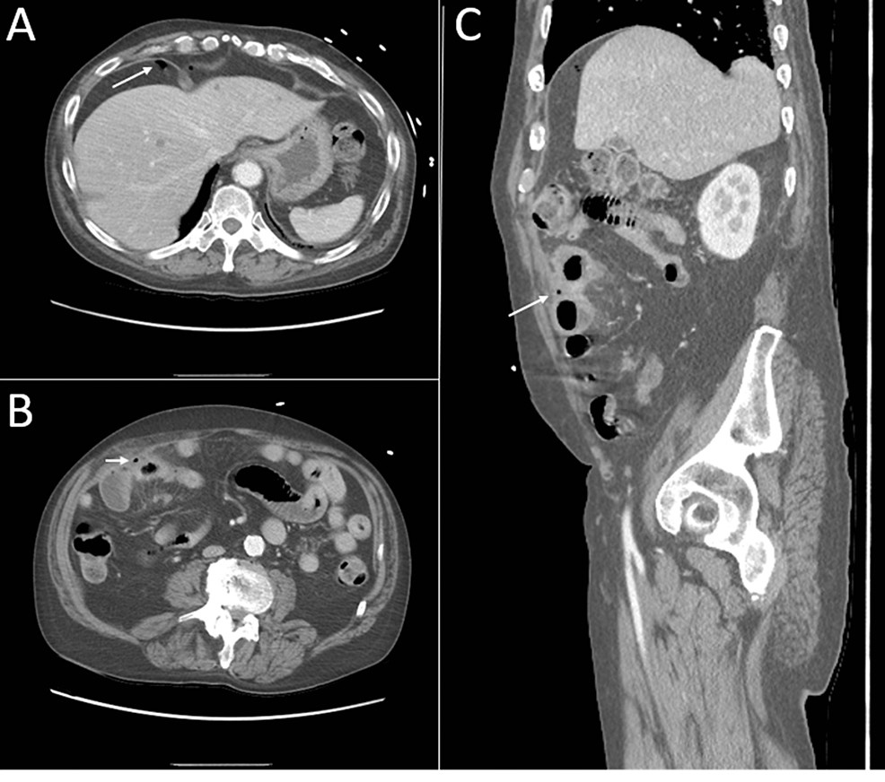 CT-of-the-abdomen-and-pelvis-with-IV-contrast