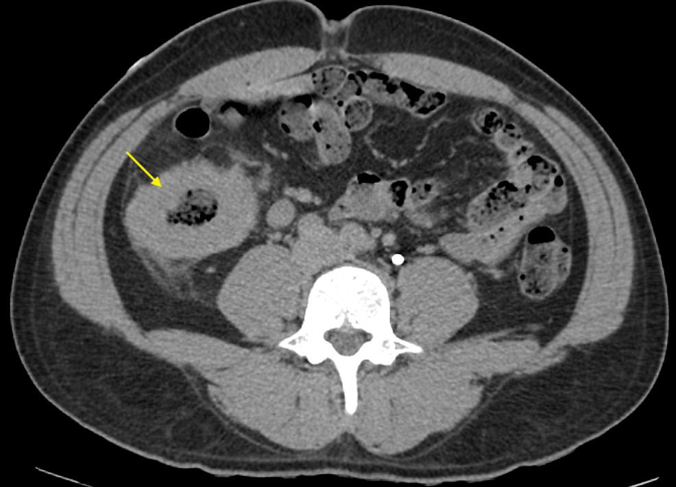 CT-abdomen-and-pelvis-with-contrast-shows-a-circumferential-wall-thickening-of-the-proximal-ascending-colon-with-prominent-lymph-nodes-(arrow).