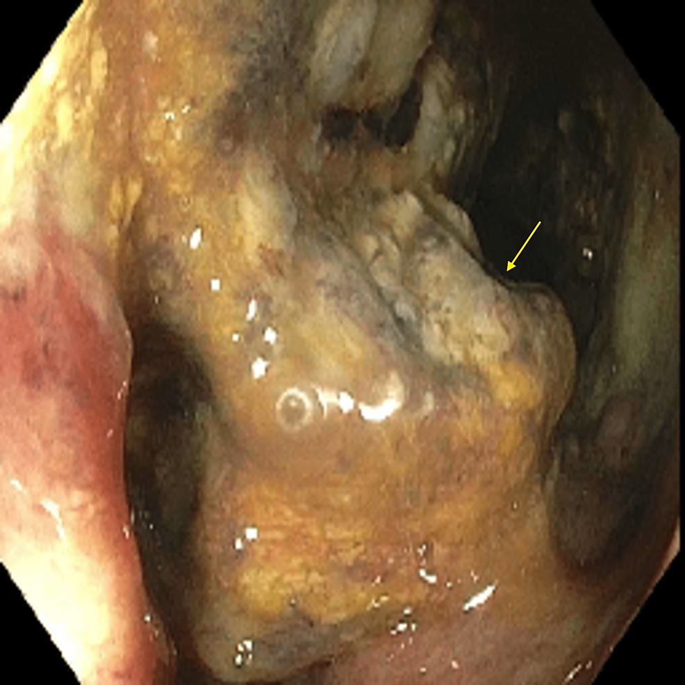 Colonoscopy-image-shows-a-30-mm-ulcerated,-circumferential-mass-extending-from-the-ileocecal-valve-to-the-hepatic-flexure.