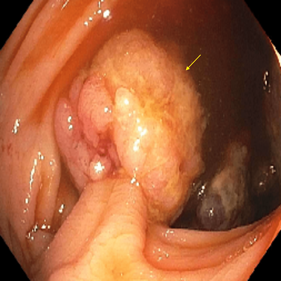 Colonoscopy-image-shows-a-20-mm-polyp-(arrow)-at-the-hepatic-flexure.