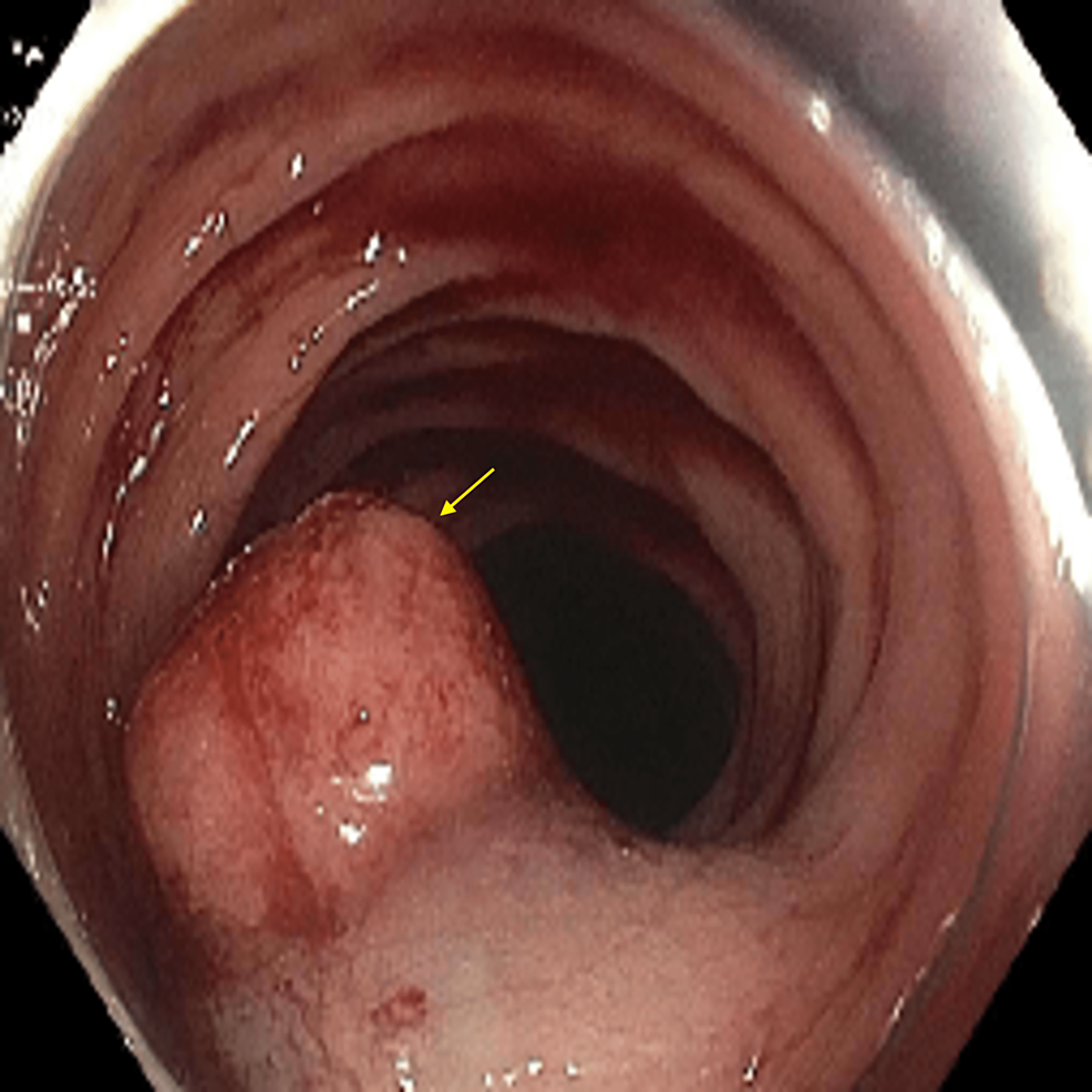 Colonoscopy-image-shows-a-20-mm-polyp-(arrow)-in-the-descending-colon.