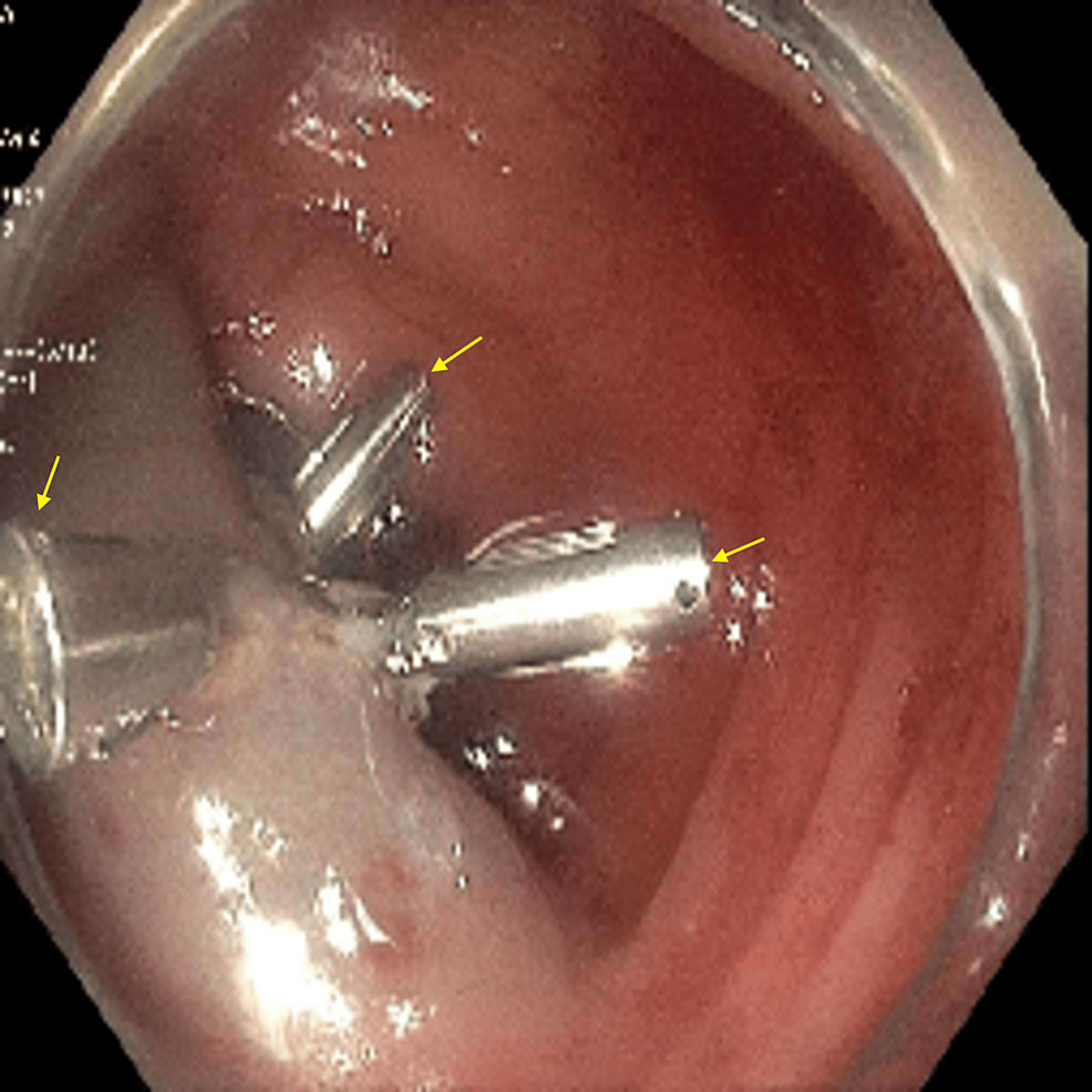 Colonoscopy-image-shows-the-descending-colon-polyp-removal-by-endoscopic-mucosal-resection.