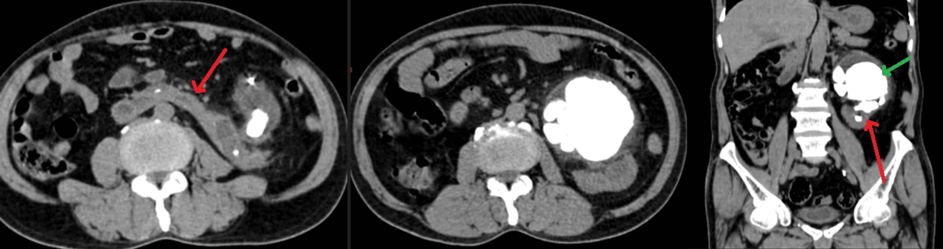 Cureus Horseshoe Kidney With a Documented Giant Calculi A Case Report