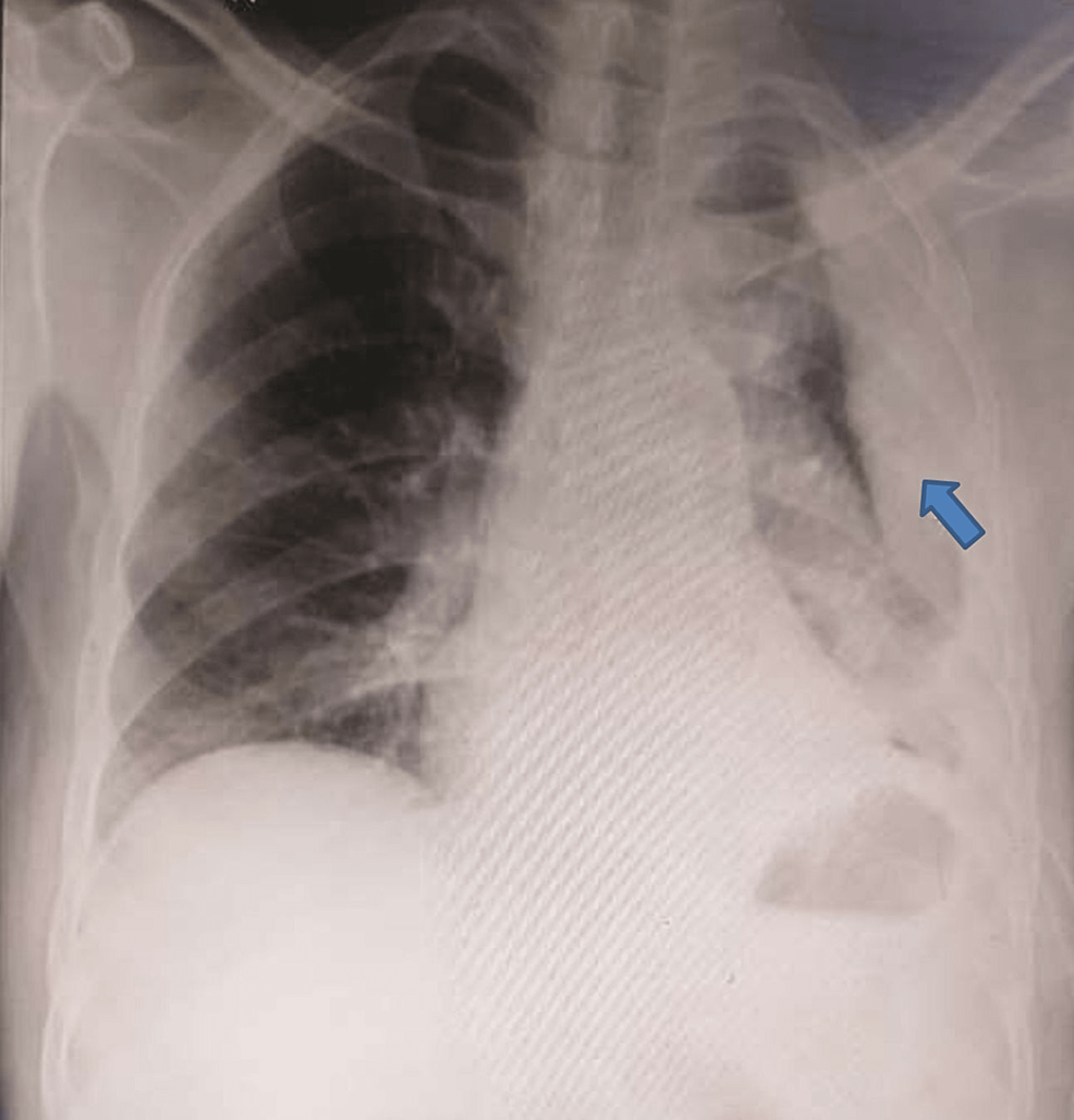Chest-X-ray-of-the-patient.