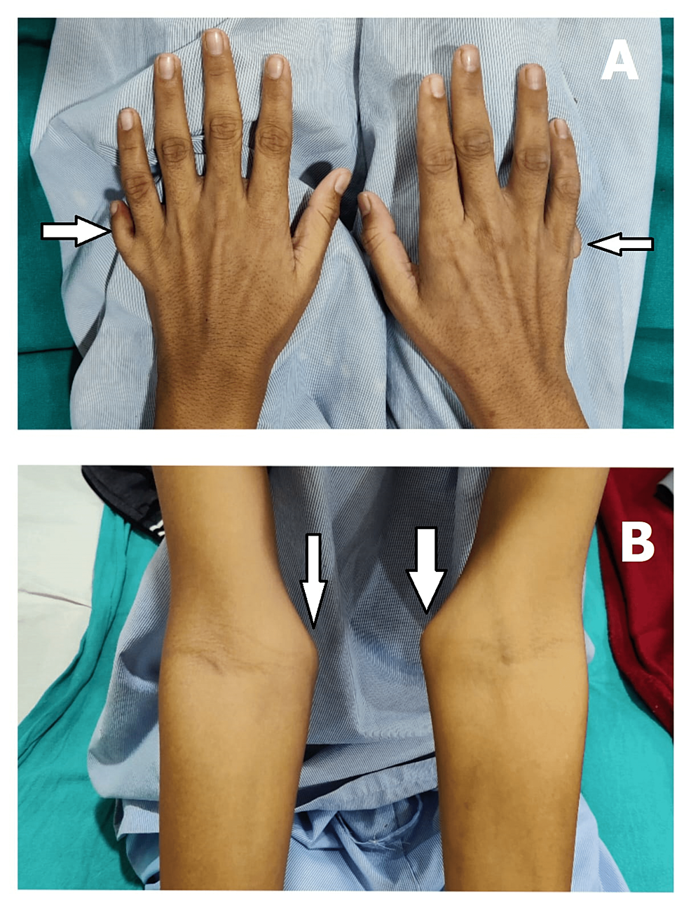 (A)-Polydactyly-and-(B)-widening-of-bony-prominences-of-long-bones