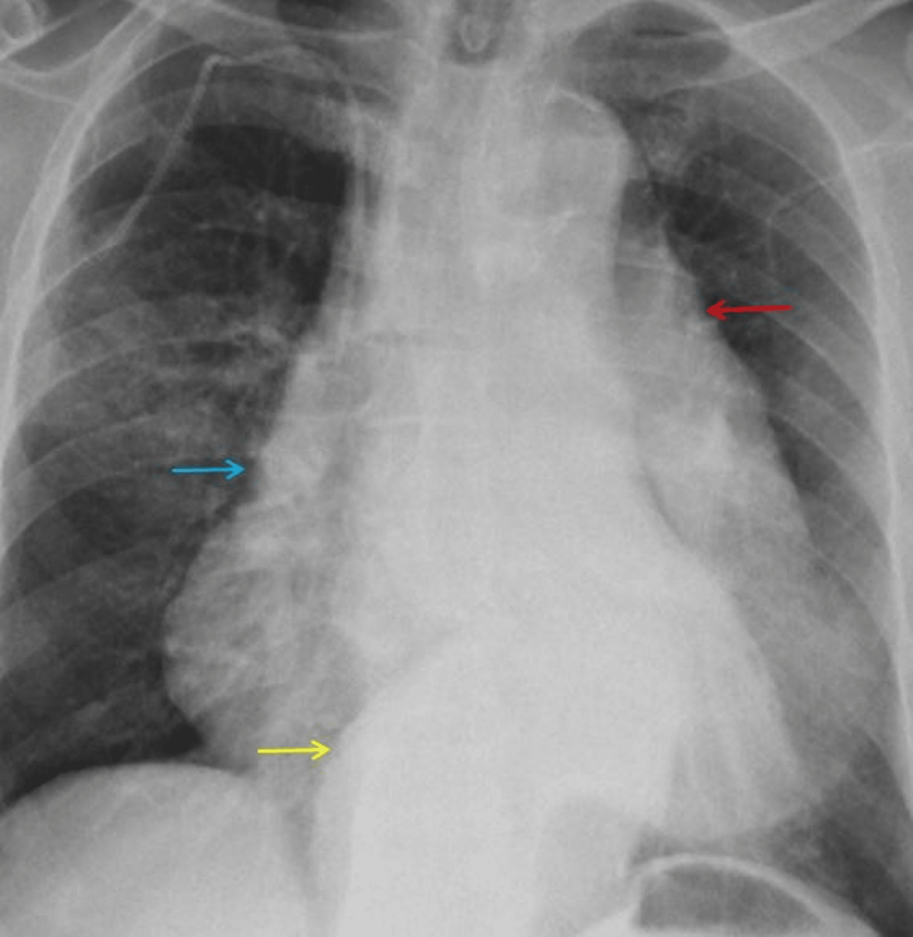 Cureus | Primary Aortoesophageal Fistula Presenting as Upper ...